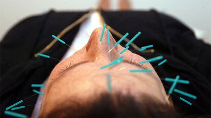 A man receives an acupuncture session.