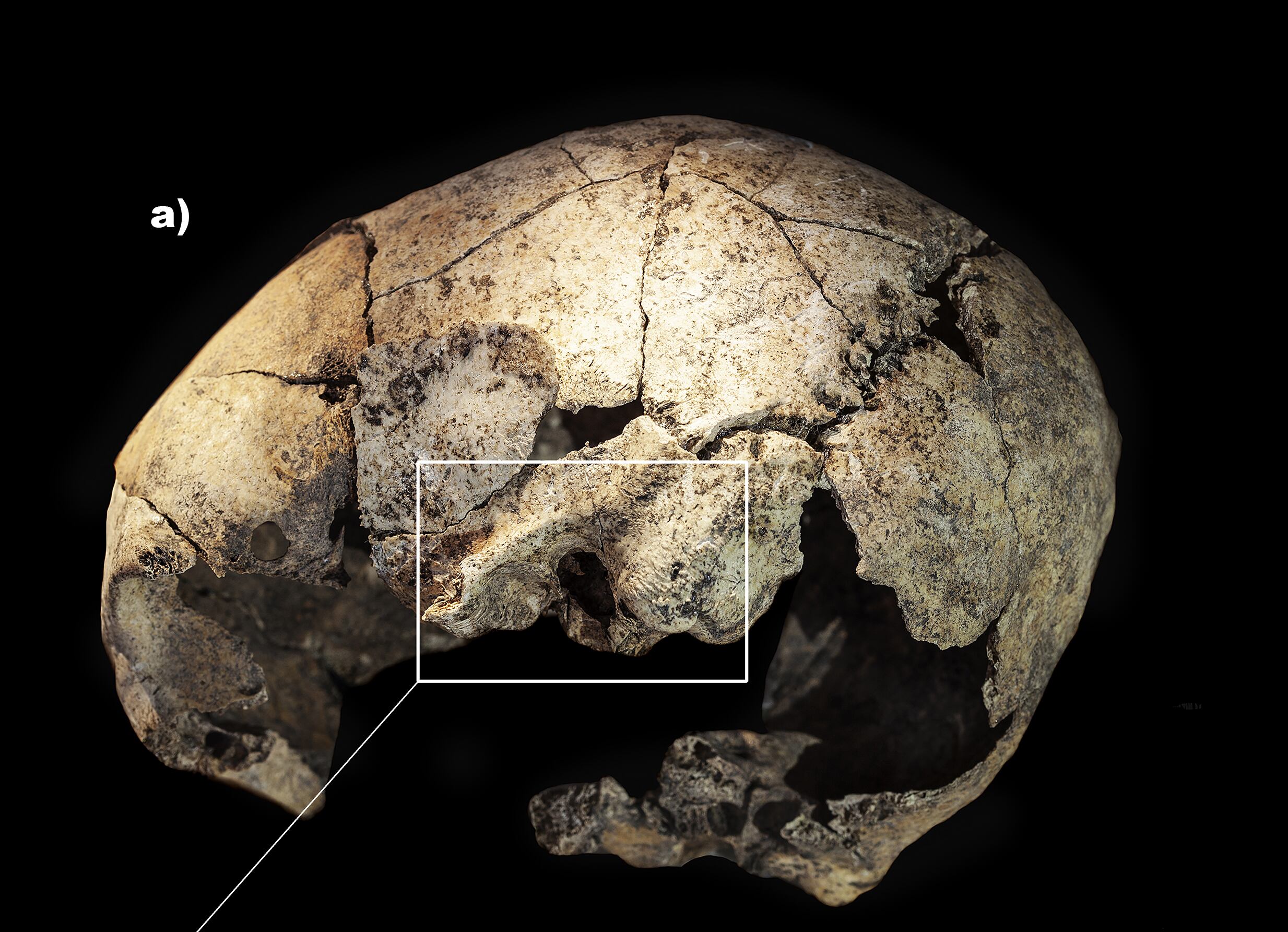The trepanned skull of the woman found in Reinoso (Burgos).