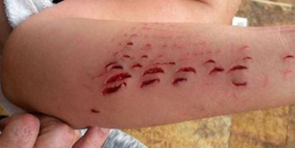 Image of the wounds left behind by the shark attack.
