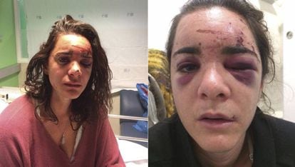 Andrea Sicignano in two photos of herself after the attack that she published on her Facebook account.