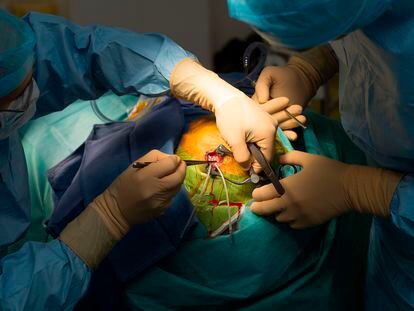 Image of the surgery required for deep brain stimulation.