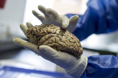 One of the brains donated for the study of the E280A mutation, at the University of Antioquia, in Medellín (Colombia).