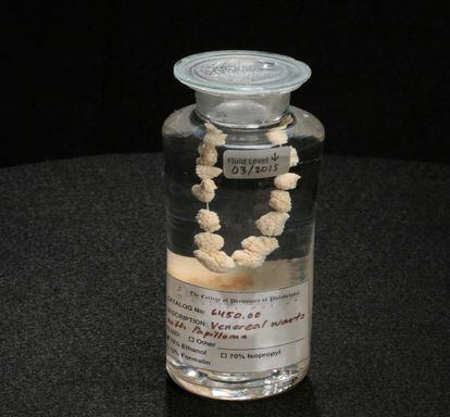 The Mütter Museum in Philadelphia has a string of genital warts made in the 19th century in its collection.