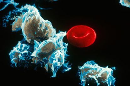 Cells with leukemia (left) next to a red blood cell.