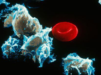 Cells with leukemia (left) next to a red blood cell.