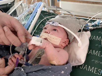 Owen Monroe, just a few weeks old, after receiving a partial heart transplant at Duke University Hospital (North Carolina, USA).