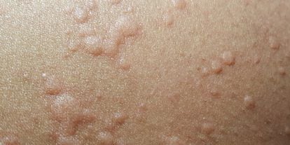 Hives, which are a possible symptom of the coronavirus.