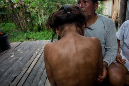 In the Sani Isla commune in the Orellana province, Damary Mayerli Grefa shows the skin problems that were caused by contact with water contaminated by the oil.
