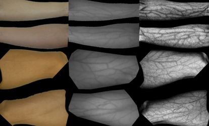 A visualization of arm vein patterns using different techniques.
