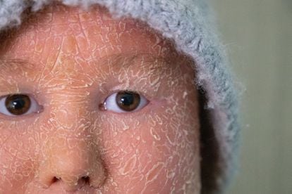 Ariadna López, 21, suffers from harlequin-type ichthyosis, a very rare dermatological ailment that causes scaling of the skin.