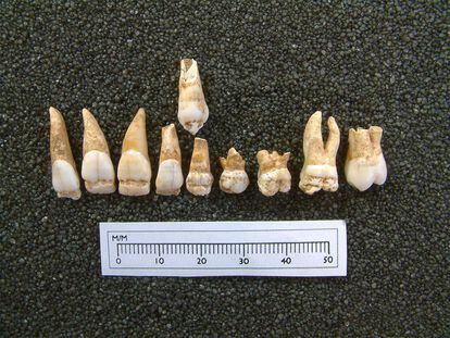 The teeth of almost all of the unearthed children had hypoplasia – an incomplete development of enamel caused by malnutrition and disease. This image shows the teeth of the young boy identified as SK 232.