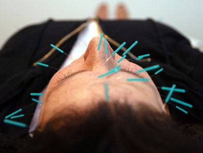 A man receives an acupuncture session.