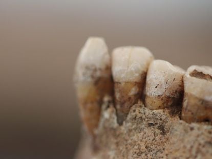 Found in southern Italy, these 5,000-year-old teeth bear visible tartar with dozens of types of bacteria.