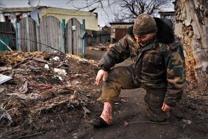 Volodymyr, 51, shows the unhealed wound on his right foot that was hit by shrapnel in September.