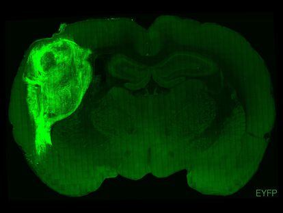 A human brain organoid, infused with a fluorescent protein and transplanted into a rat’s brain.