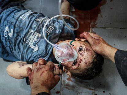 An injured child receives treatment at the Al-Aqsa Martyrs Hospital following attacks by the Israeli army, in Deir Al-Balah, Gaza, on Monday.