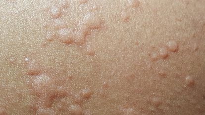 Hives, which are a possible symptom of the coronavirus.