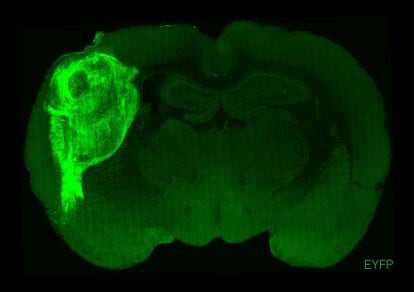 A human brain organoid, infused with a fluorescent protein and transplanted into a rat’s brain.