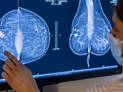 Health personnel analyze a mammogram in a hospital in Berlin, Germany.
