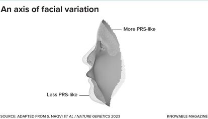 Pierre Robin sequence (PRS) is a craniofacial disorder characterized in part by a small lower jaw and caused by a mutation in the regulatory gene SOX9. Researchers sorted normal faces according to how much or how little they resembled the features of PRS, and then looked for associated gene variants. The researchers found that some genes are very sensitive to SOX9, dialing facial variation toward or away from PRS-like facial features. If other axes of facial variation are determined in a similar way, this could mean that the genetics of faces may be simpler than they seem.