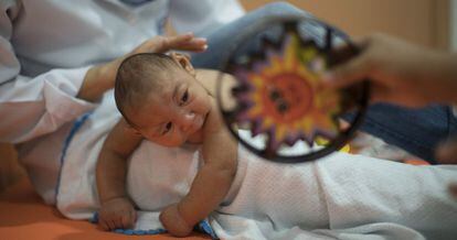 A baby born with microcephaly in Recife, Brazil.