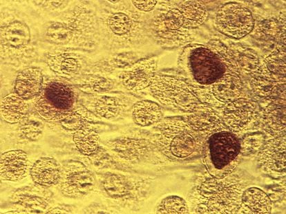 This 1975 microscope image made available by the the Centers for Disease Control and Prevention shows Chlamydia trachomatis bacteria