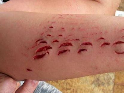 Image of the wounds left behind by the shark attack.