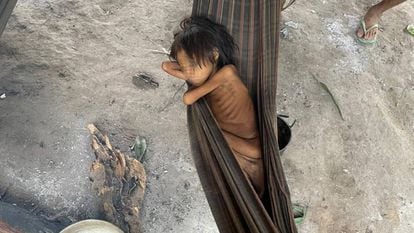 A Yanomami girl suffering from malnutrition and malaria in Maimasi, Brazil.