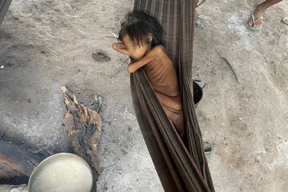 A Yanomami girl suffering from malnutrition and malaria in Maimasi, Brazil.