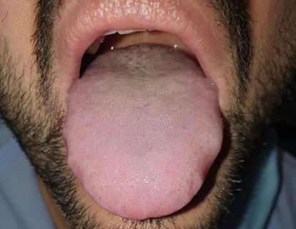 The tongue of a Covid-19 patient.