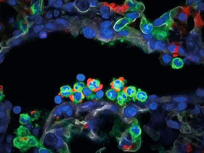 Neutrophils (in green), one of the first immune cells to react in the body, infiltrate a damaged lung.