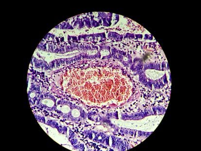 A colon tumor seen through the microscope.