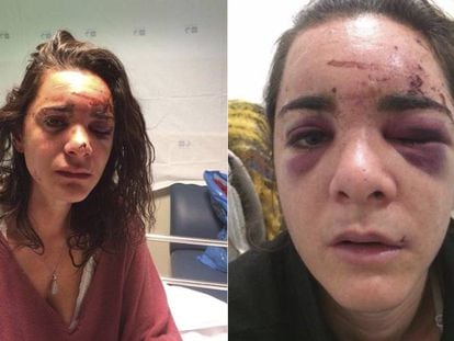 Andrea Sicignano in two photos of herself after the attack that she published on her Facebook account.