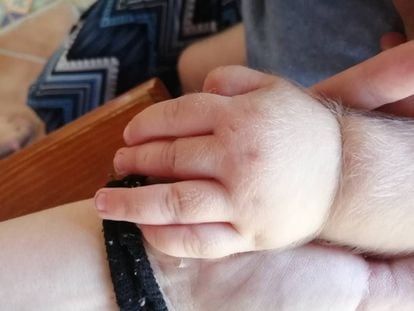 The hand of one of the babies affected by hypertrichosis.