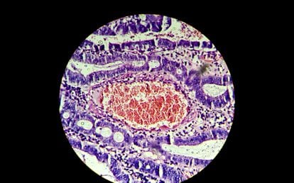 A colon tumor seen through the microscope.