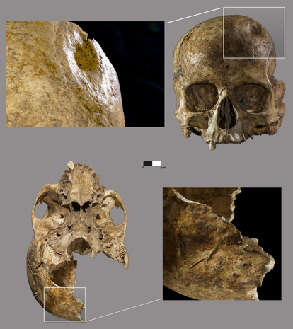 Evidence of trepanation and other injuries on the skull of the woman found at Dehesilla.