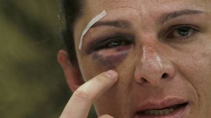 Ana Gabriela Guevara shows her shattered cheekbone.