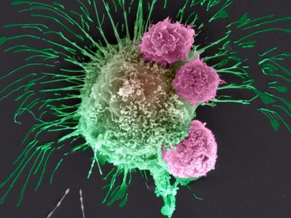 A breast cancer cell (left) being attacked by three lymphocites.