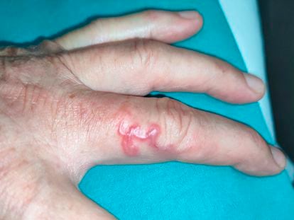 One of Spain’s latest cases of cutaneous larva migrans, a 75-year-old patient from Cantabria who contracted the disease while working in an orchard.