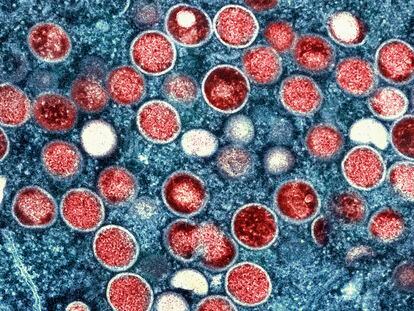 A colorized electron microscope image provided by the National Institute of Allergy and Infectious Diseases shows monkeypox particles.