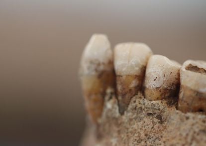 Found in southern Italy, these 5,000-year-old teeth bear visible tartar with dozens of types of bacteria.