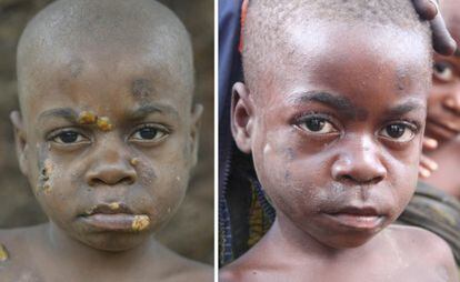A child before and after his treatment for yaws.