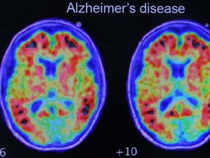 Evidence of Alzheimer’s disease in a study conducted with positron emission tomography.