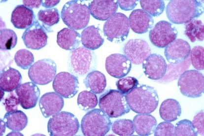 Blood cells infected with the Epstein-Barr Virus.