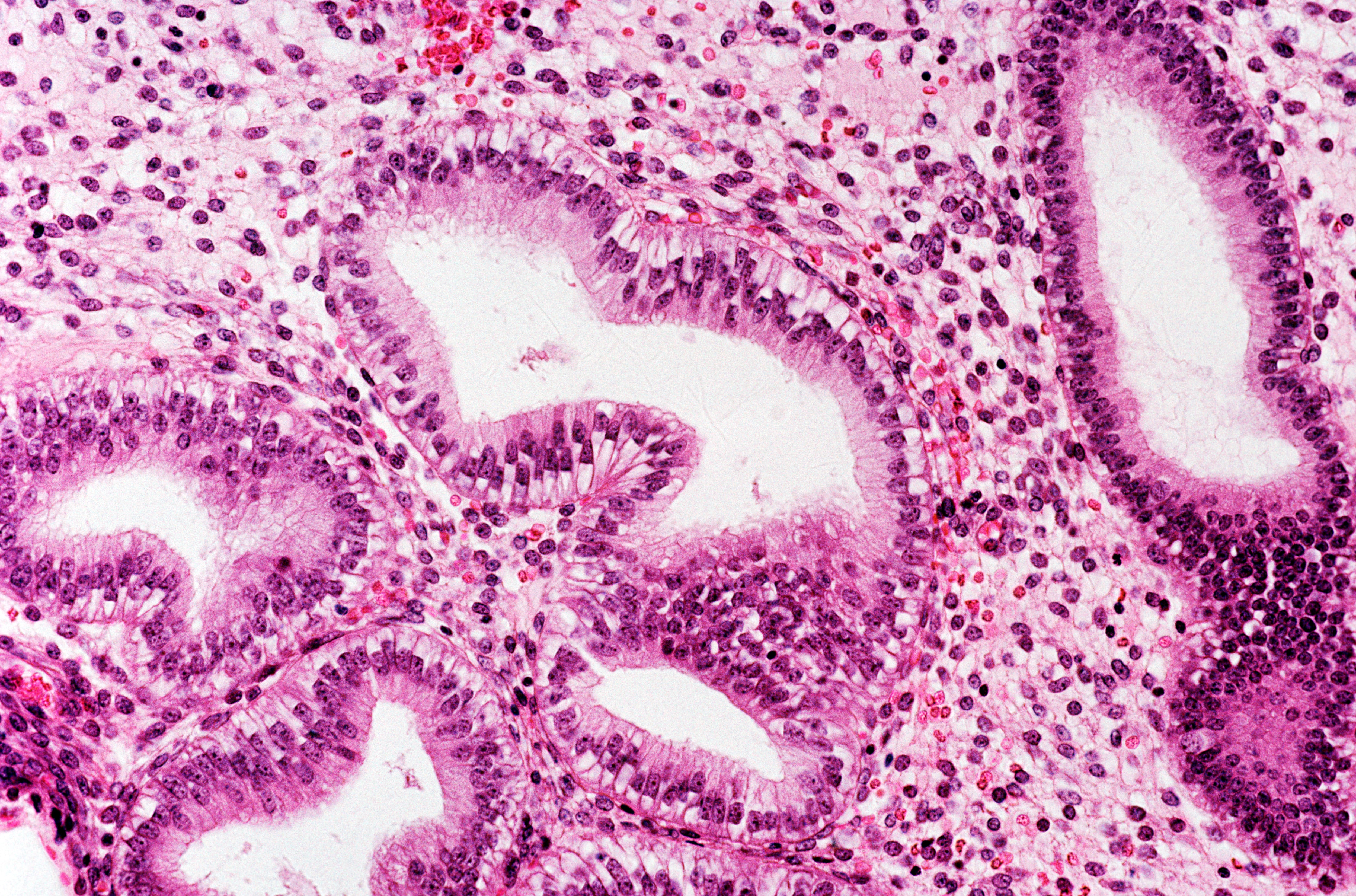 A new map of the endometrium opens the door to possible treatments for endometriosis