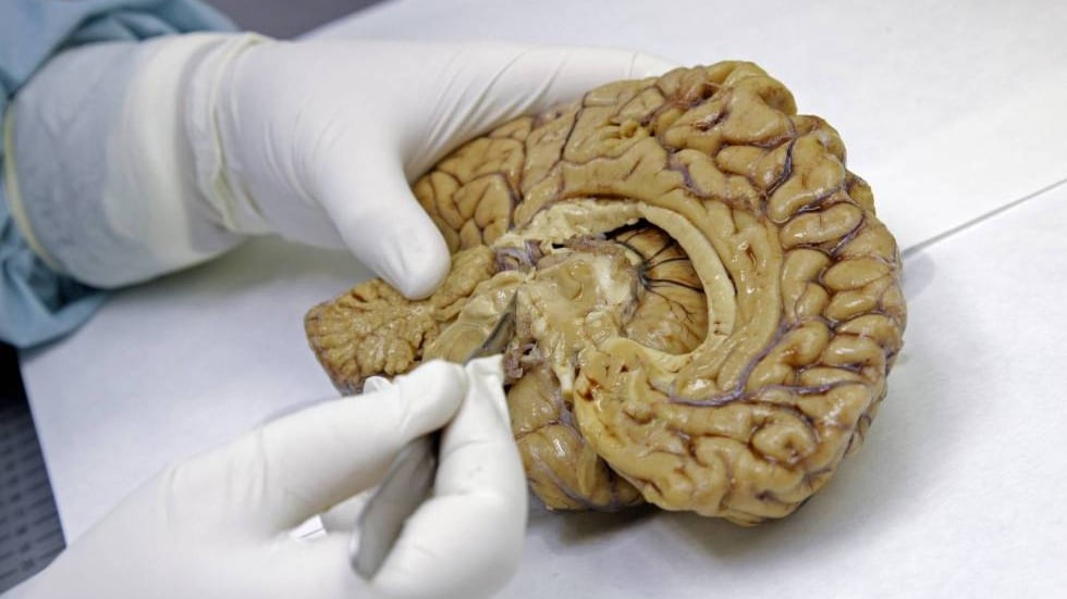 Blood test can detect early symptoms, 10 years before onset of Alzheimer’s