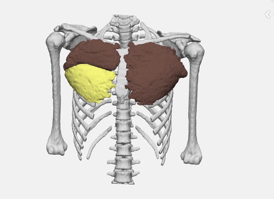 Computer-generated image of the reconstruction of the mold used to make Mario Rielo's prosthesis.