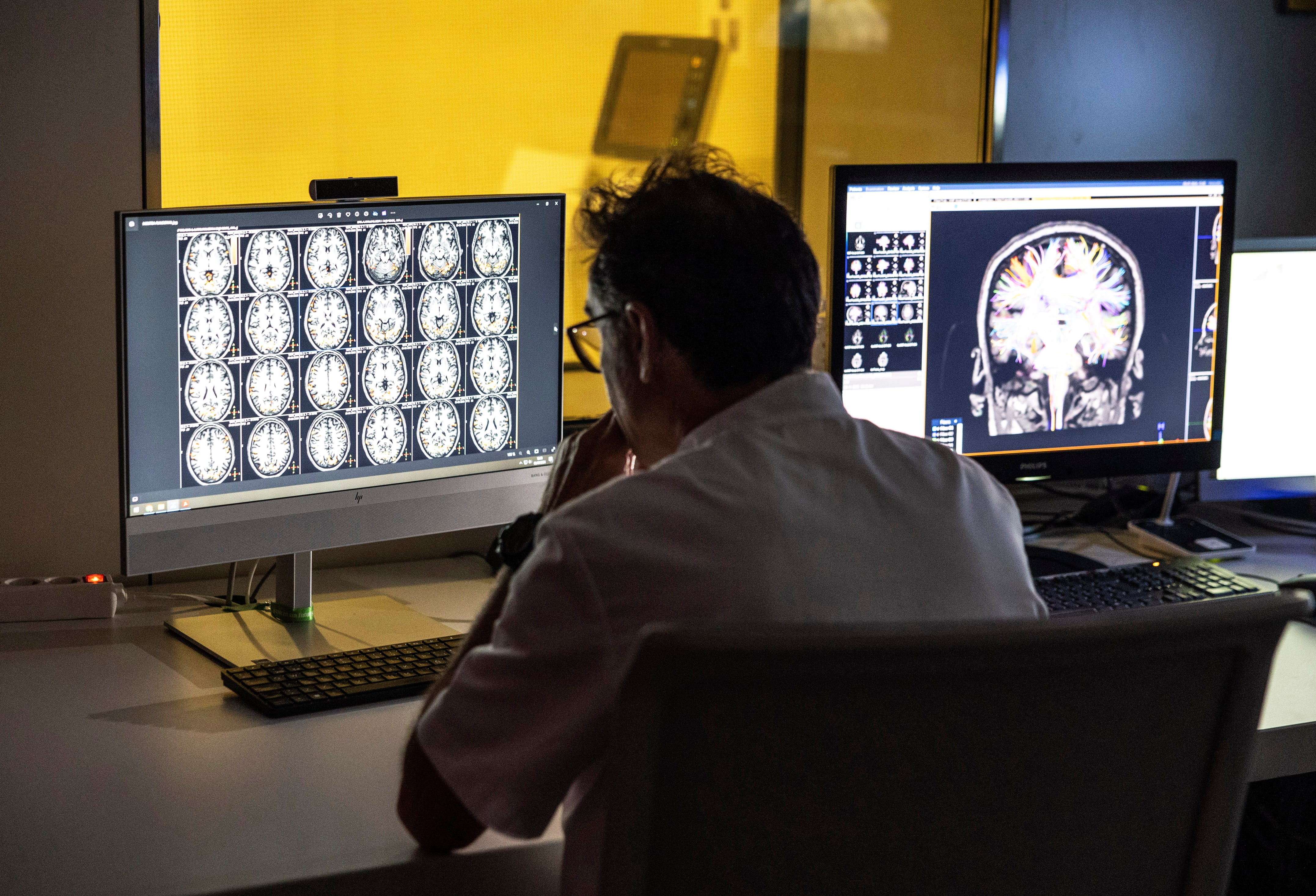 The great revolution against Alzheimer’s: ‘It’s the first time in human history that we’ve managed to slow the disease’