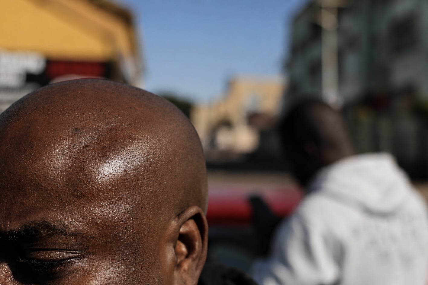 A Congolese refugee shows the effects of the beating he sustained in Durban on July 5, 2026. 