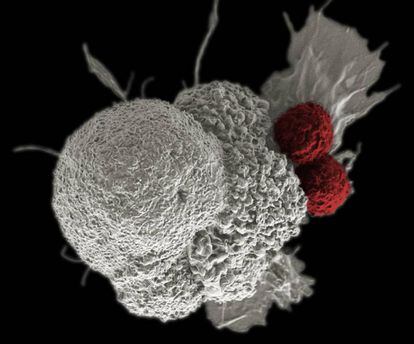 A cancer cell being attacked by two white cells.